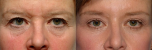 patient before and after blepharoplasty