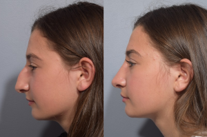 patient before and after teenage rhinoplasty