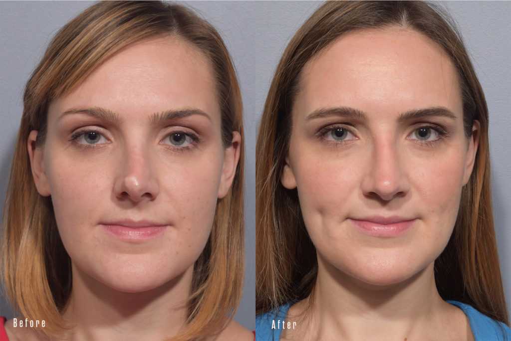before and after revision rhinoplasty