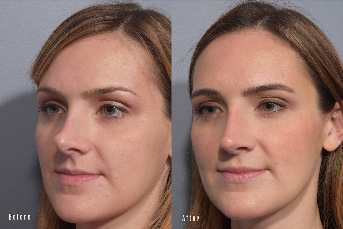before and after revision rhinoplasty