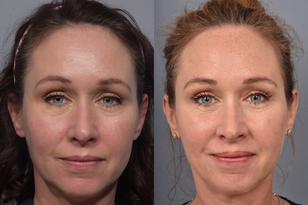 patient before and after FaceTite