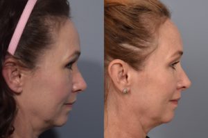 patient before and after FaceTite