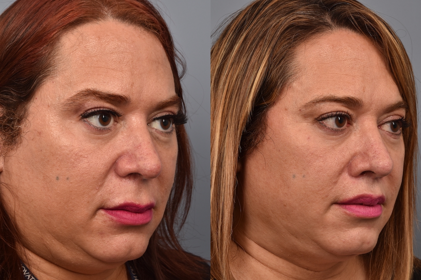 patient before and after lip lift