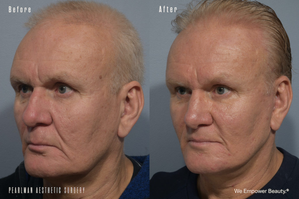 patient before and after lip lift
