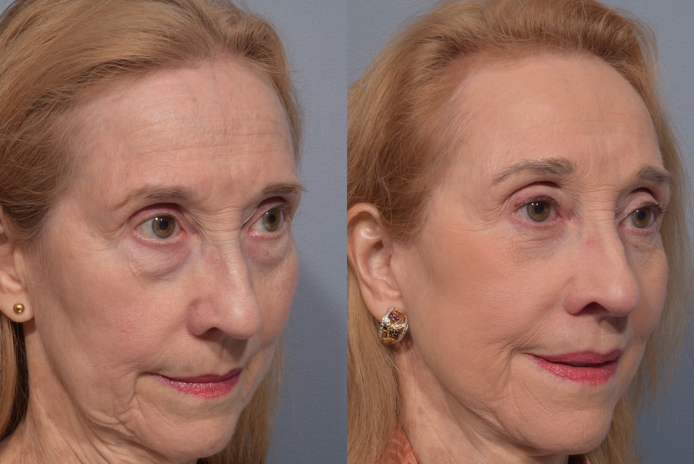 patient before and after brow lift