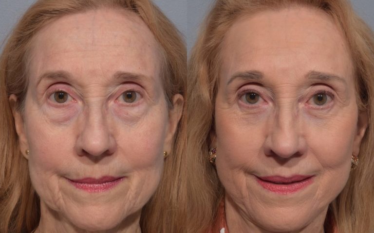 patient before and after brow lift