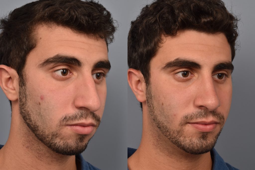 patient before and after chin implant