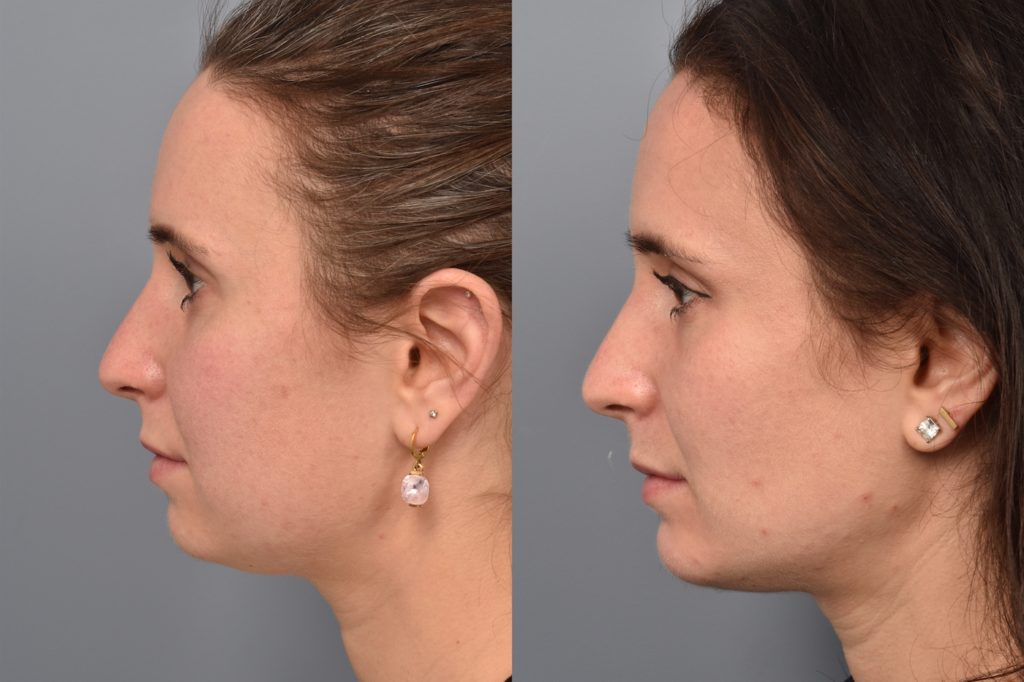patient before and after chin implant