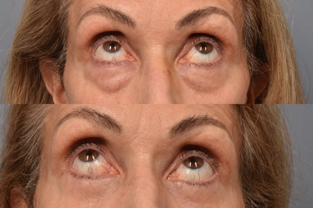 patient before and after eyelid surgery