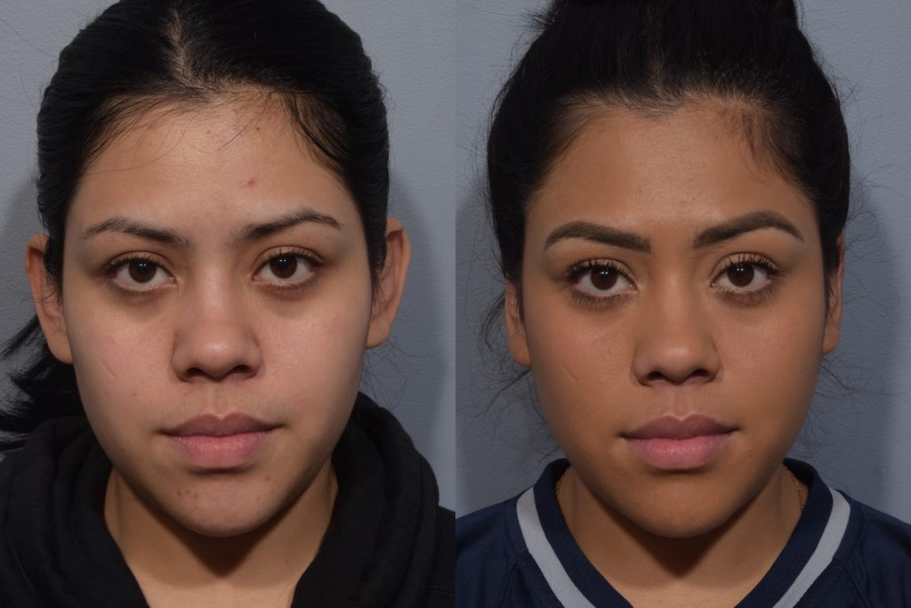 Female patient before and after Ear Reconstruction Surgery in NYC.