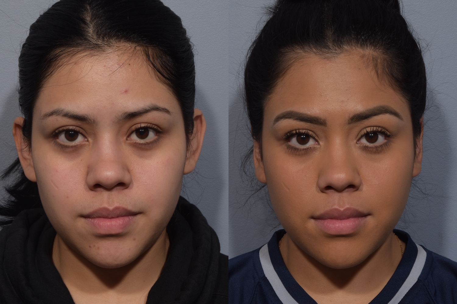 patient before and after otoplasty