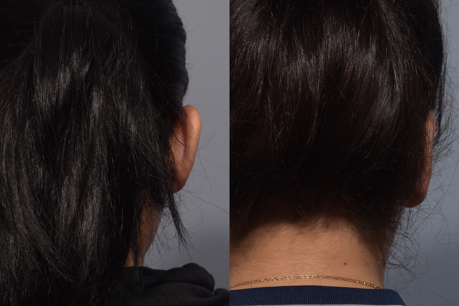 patient before and after otoplasty