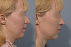 patient before and after neck lipo