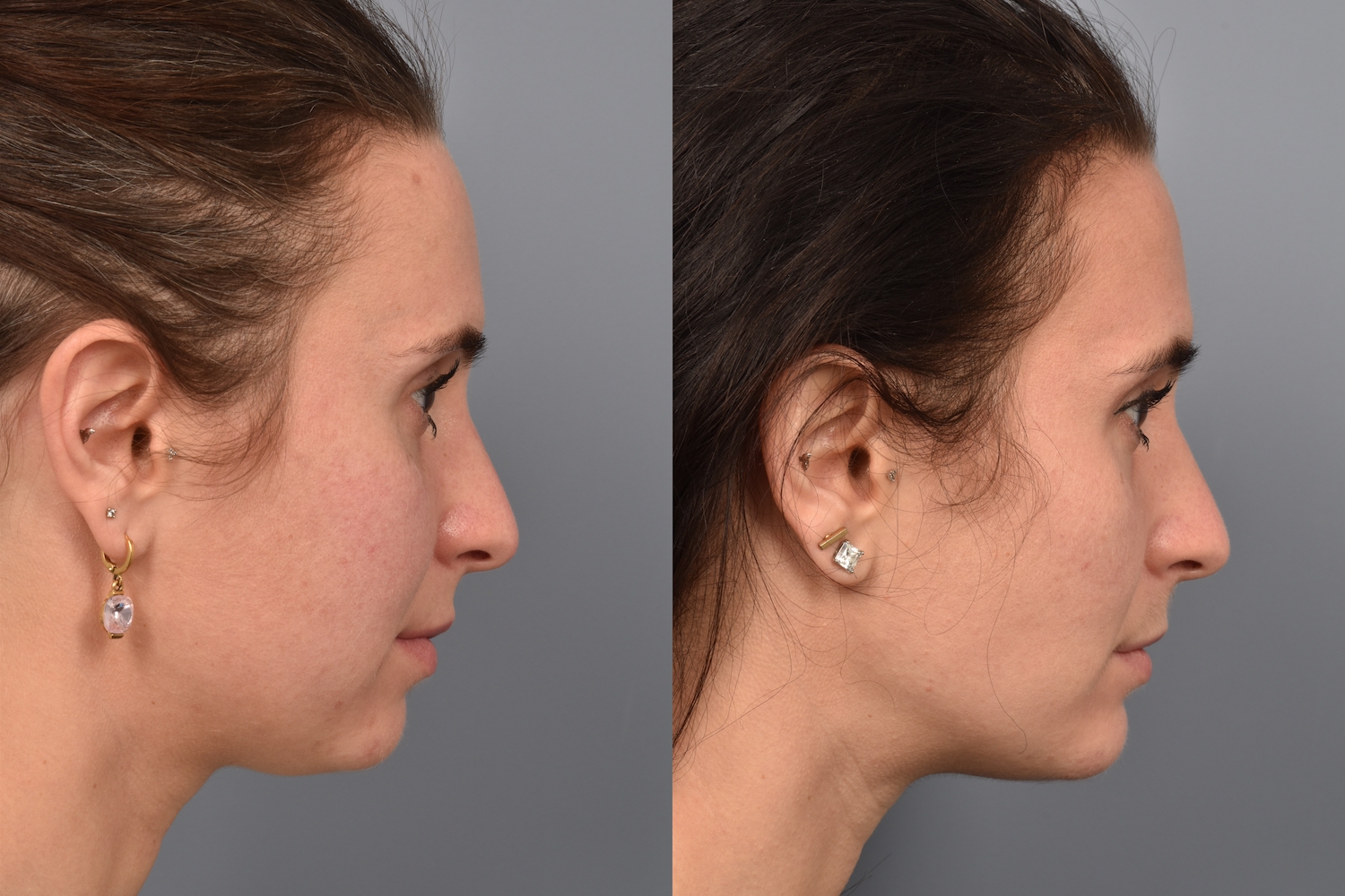 patient before and after buccal fat removal