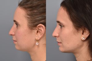 patient before and after buccal fat removal