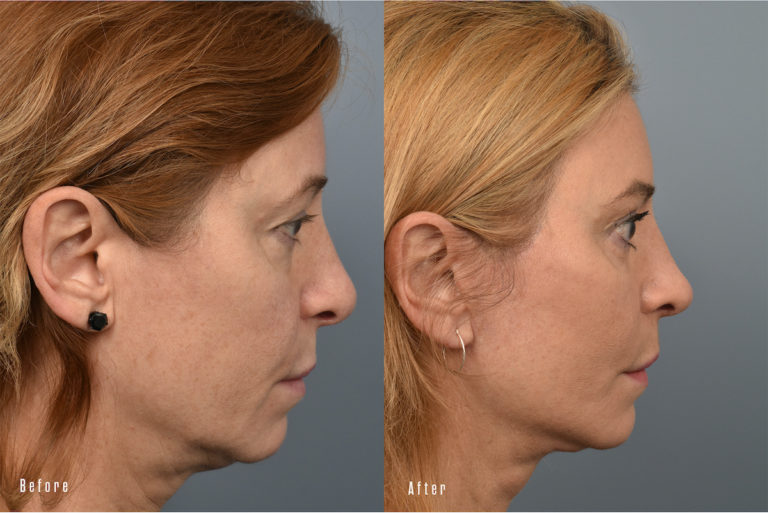 patient before and after facelift