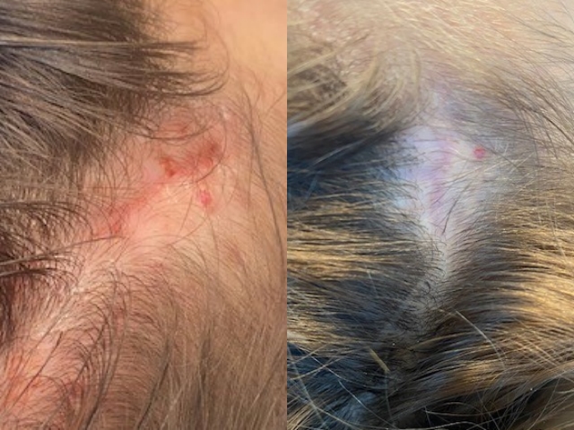 patient before and after PRP