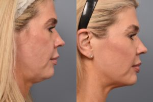 patient before and after ultherapy