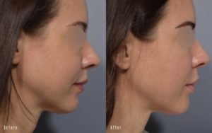 patient before and after ultherapy