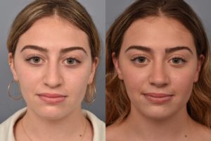 patient before and after rhinoplasty