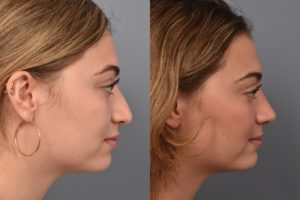 patient before and after rhinoplasty