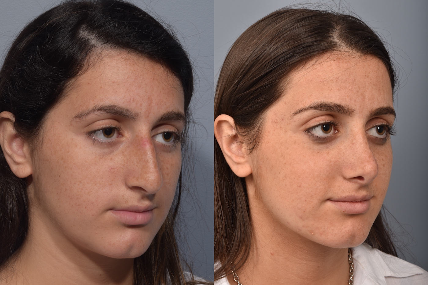 patient before and after rhinoplasty