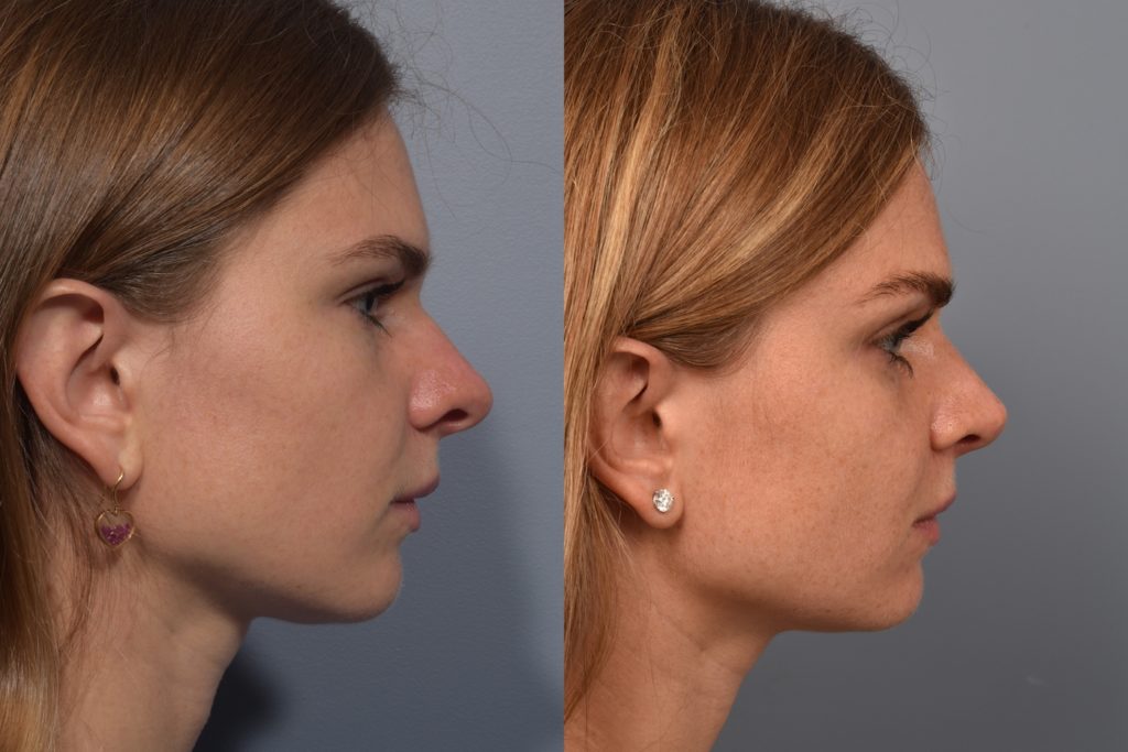 patient before and after rhinoplasty