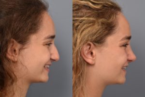 Female Teenage rhinoplasty before and after