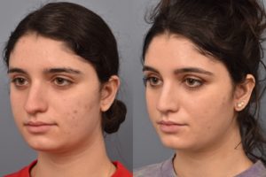 patient before and after rhinoplasty
