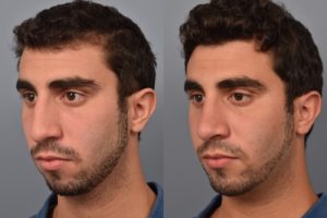 patient before and after rhinoplasty and chin implant