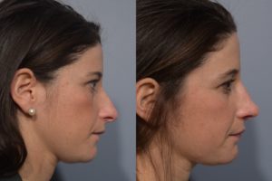 patient before and after septoplasty