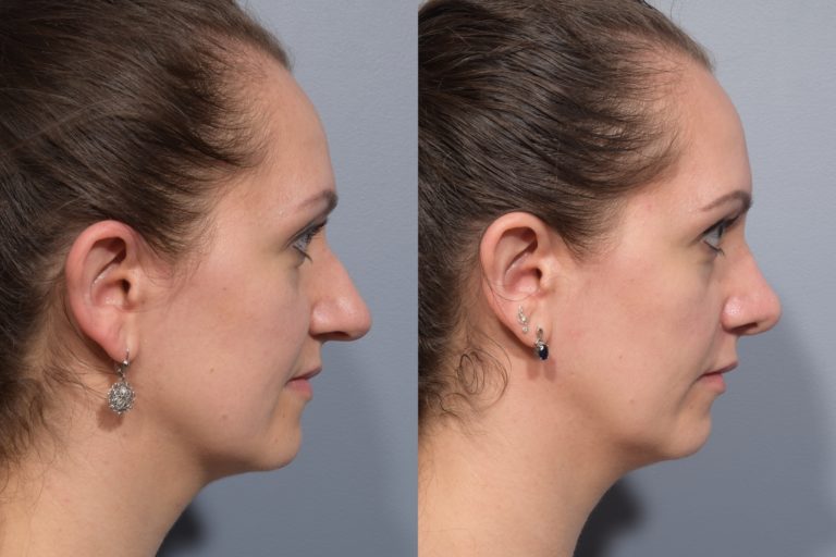 patient before and after septoplasty