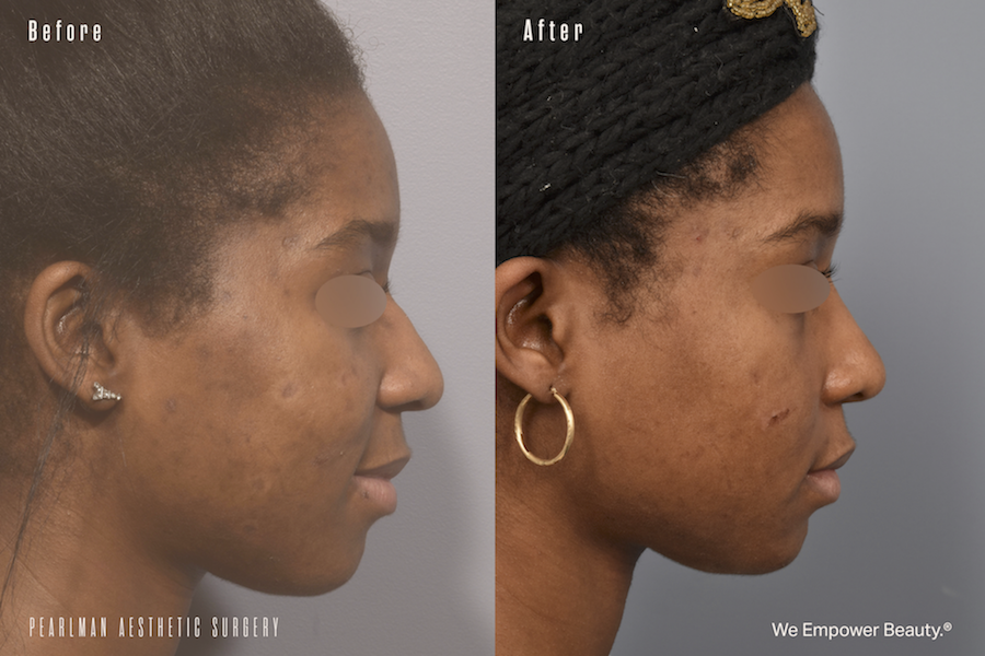 patient before and after ethnic rhinoplasty