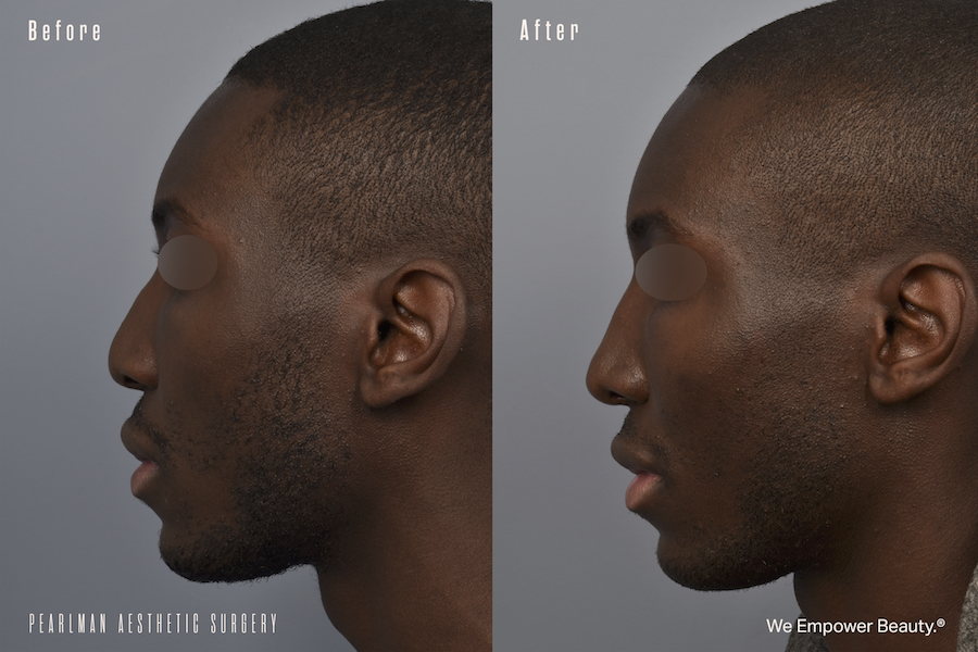 patient before and after ethnic rhinoplasty