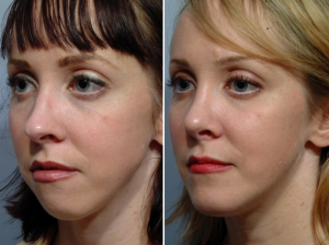 surgeries enhance facial structure