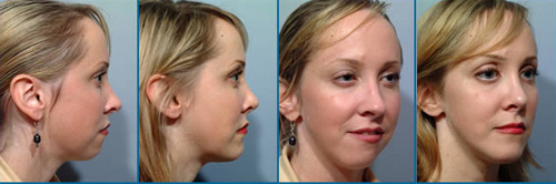 advantages facial implants fillers