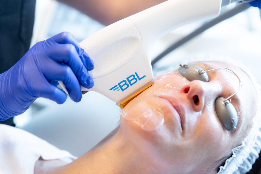 BBL applicator on woman's face with protective goggles