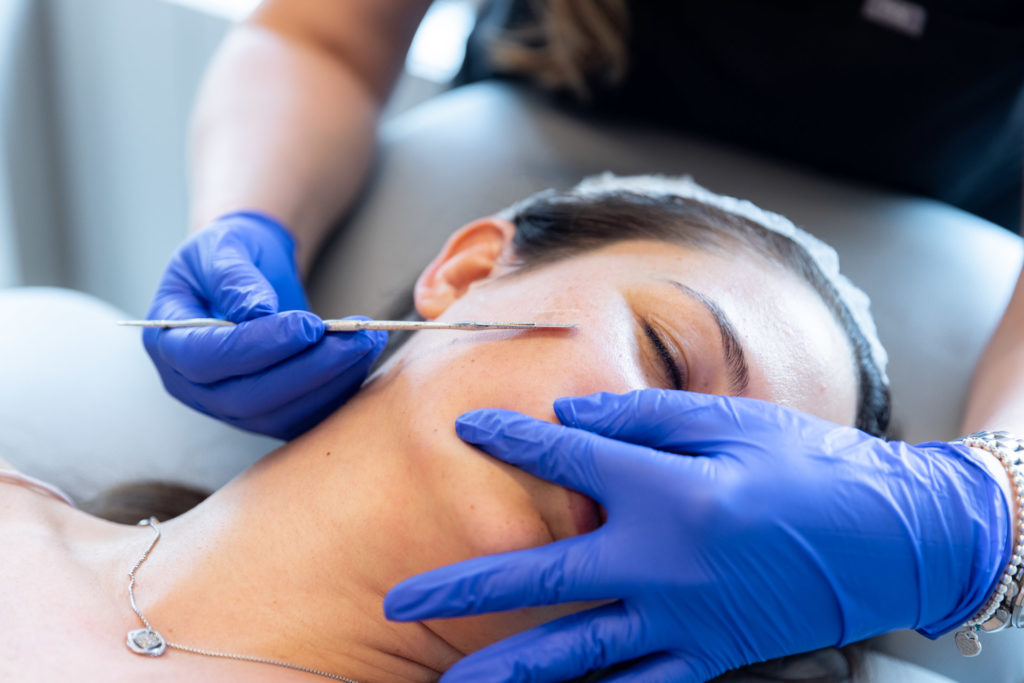 using a tool on woman's face for chemical peel