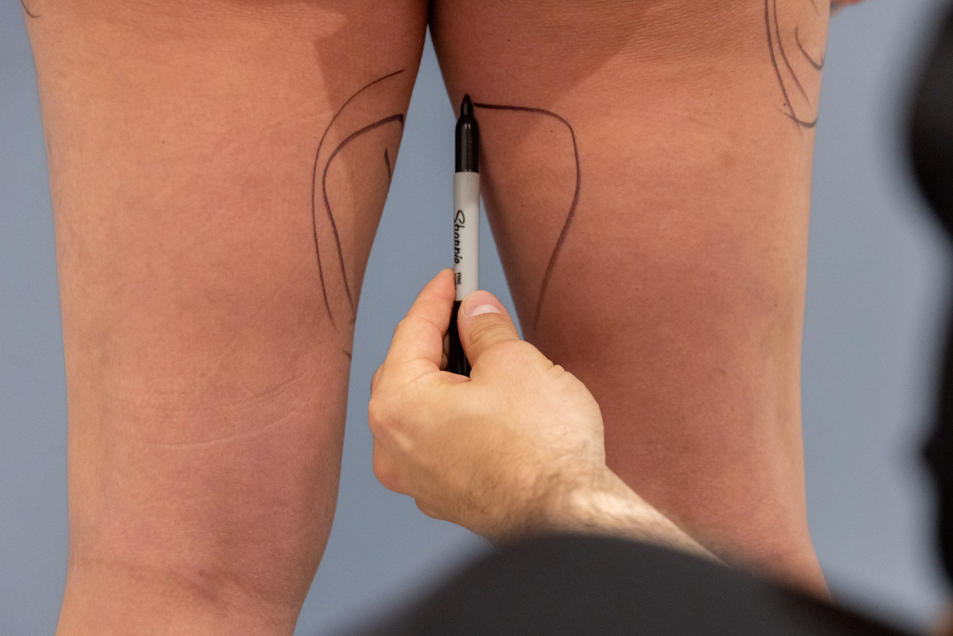 Dr. Stein Surgical Consultation drawn on the patient's inner thighs
