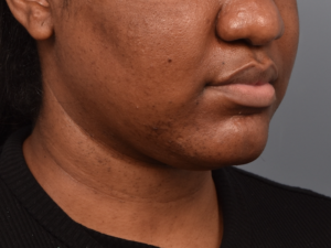 patient before Kybella