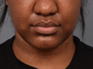 patient before Kybella