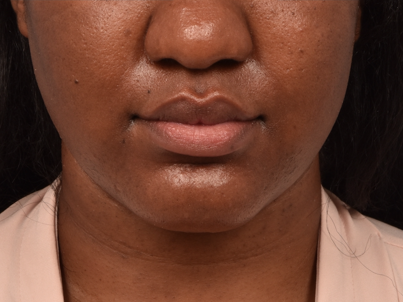 patient after Kybella