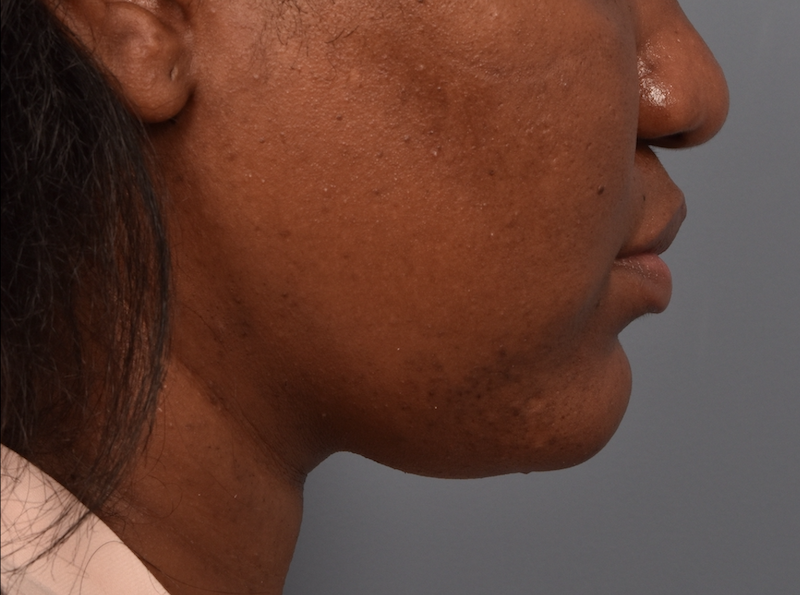 patient after Kybella