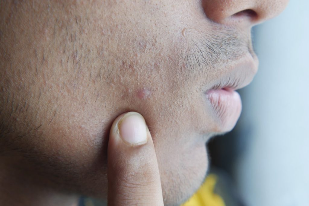 man with facial hair pointing at a pimple