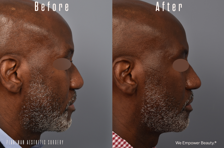 patient before and after african rhinoplasty