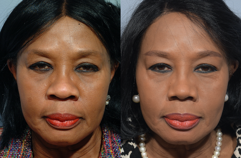 https://mdface.com/wp-content/uploads/2022/01/african-rhinoplasty-patient-2-1.png