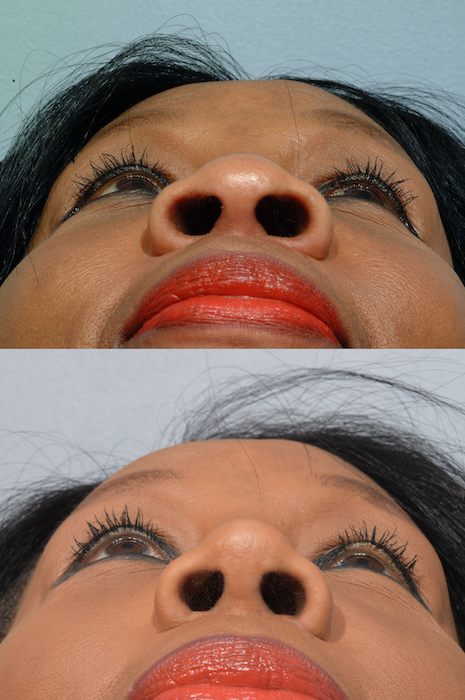 https://mdface.com/wp-content/uploads/2022/01/african-rhinoplasty-patient-2.png
