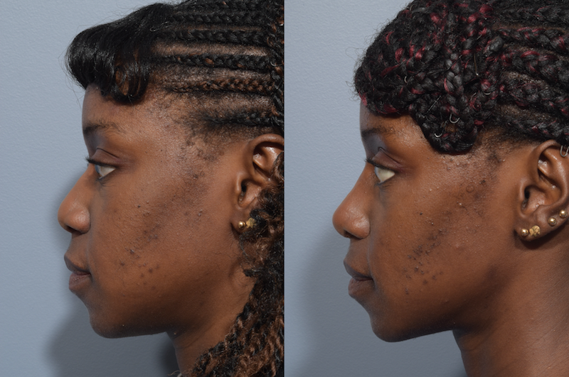 https://mdface.com/wp-content/uploads/2022/01/african-rhinoplasty-patient-3-1.png