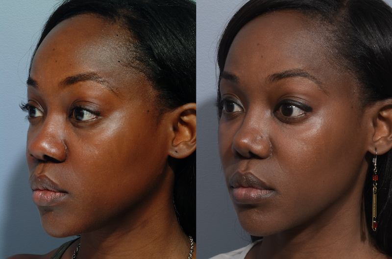 patient before and after african rhinoplasty
