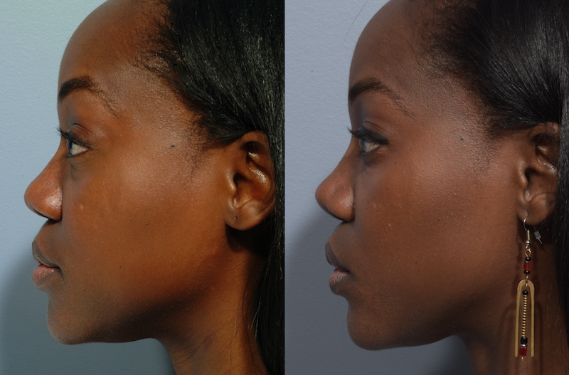 https://mdface.com/wp-content/uploads/2022/01/african-rhinoplasty-patient-4-3.png